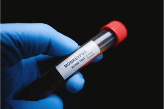 Variole du singe (Mpox) : le Maroc renforce son dispositif de surveillance face à la recrudescence mondiale